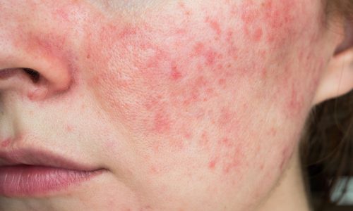papulopustular rosacea, close-up of the patient's cheek