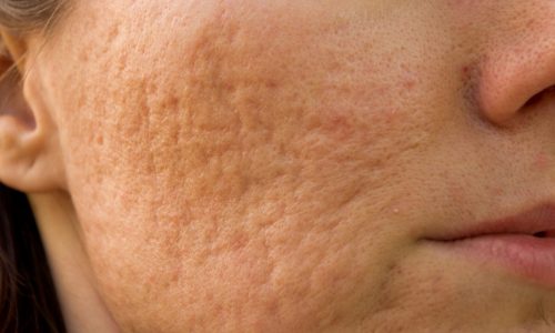 Acne cicatrici